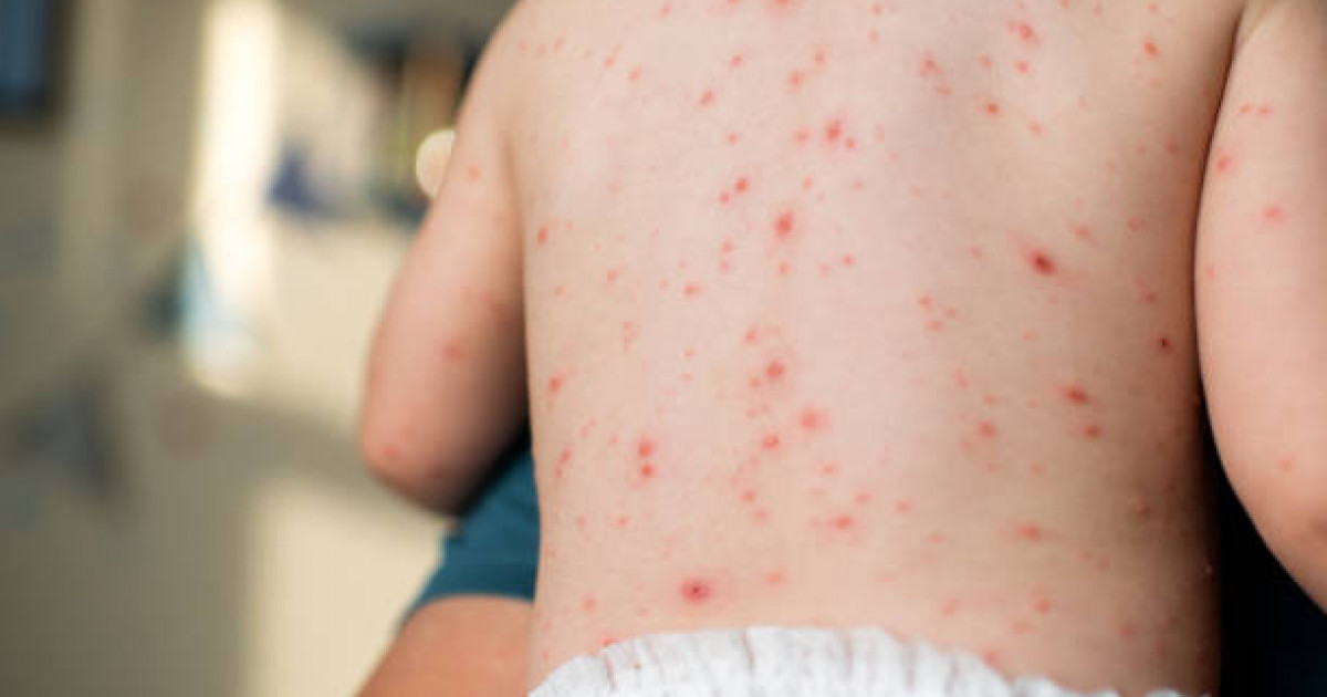 Қазақстанда 1 363 бала қызылша жұқтырған