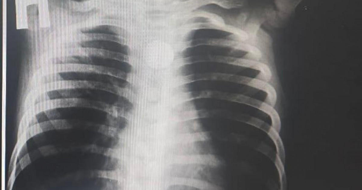 Дәрігерлер өңешіне батарея тұрып қалған баланы құтқарды