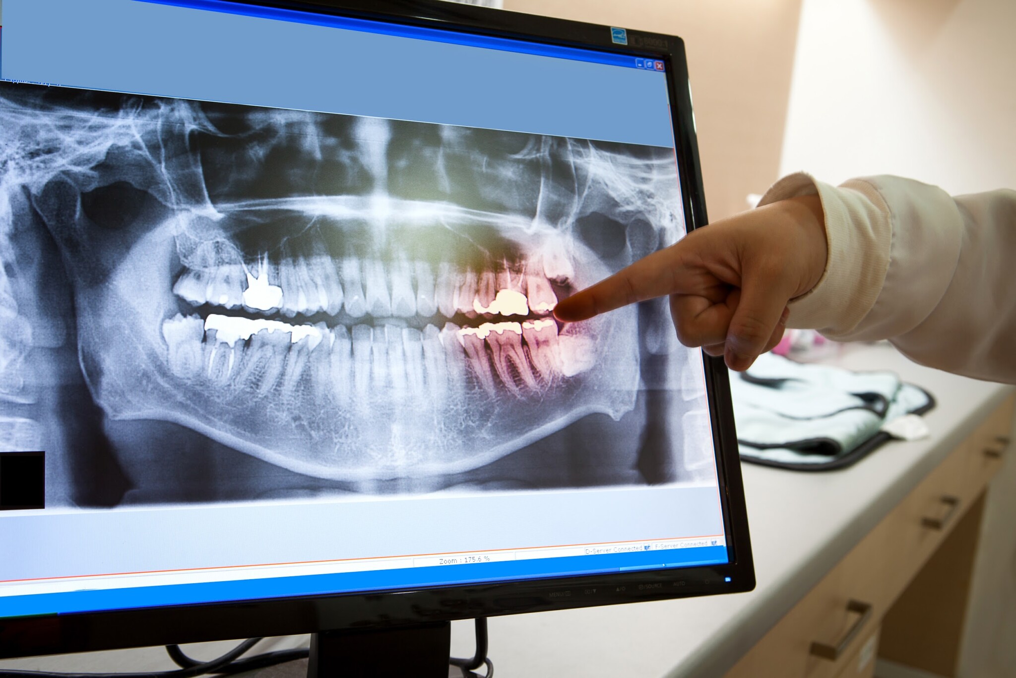 Астаналық әйел тісінде стоматологтың құрал-сайманы қалып кеткенін бір жылдан кейін білді