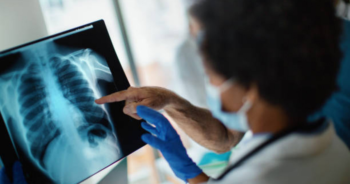 Шығыс Қазақстанда пневмонияға шалдыққандар саны күрт көбейді