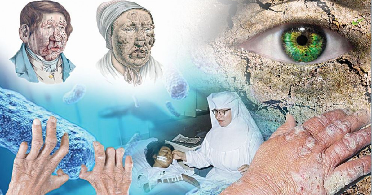 Хансен дерті: кеселмен күрес қалай жүргізілді?