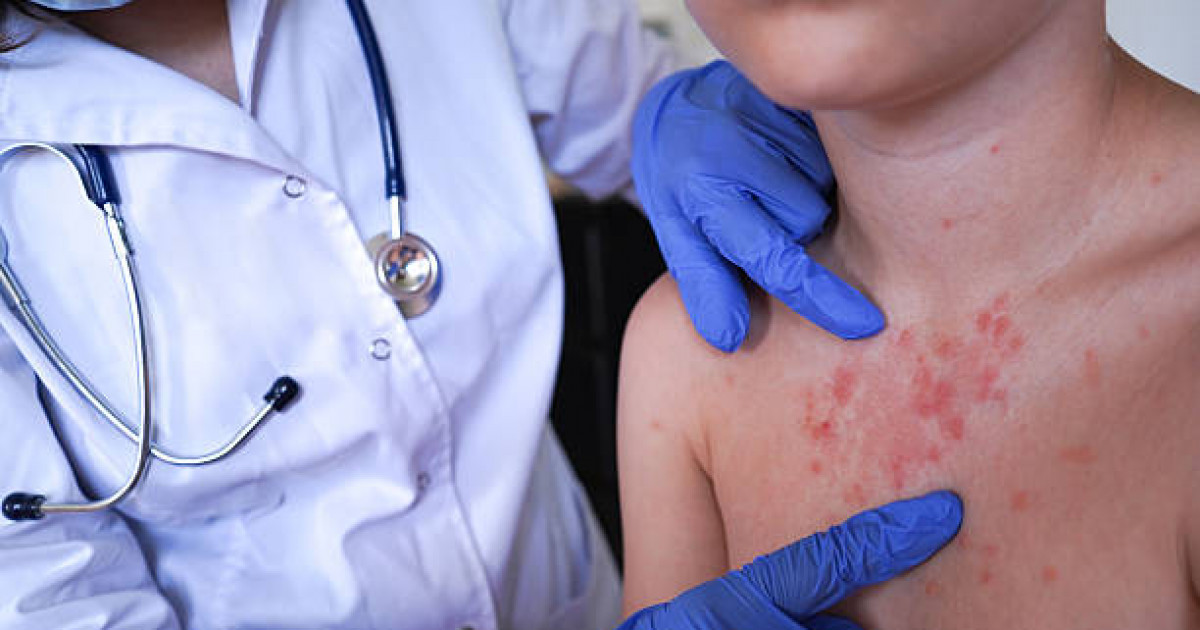 Елордада қызылша өршіді: 1 470 хабарлама тіркелді