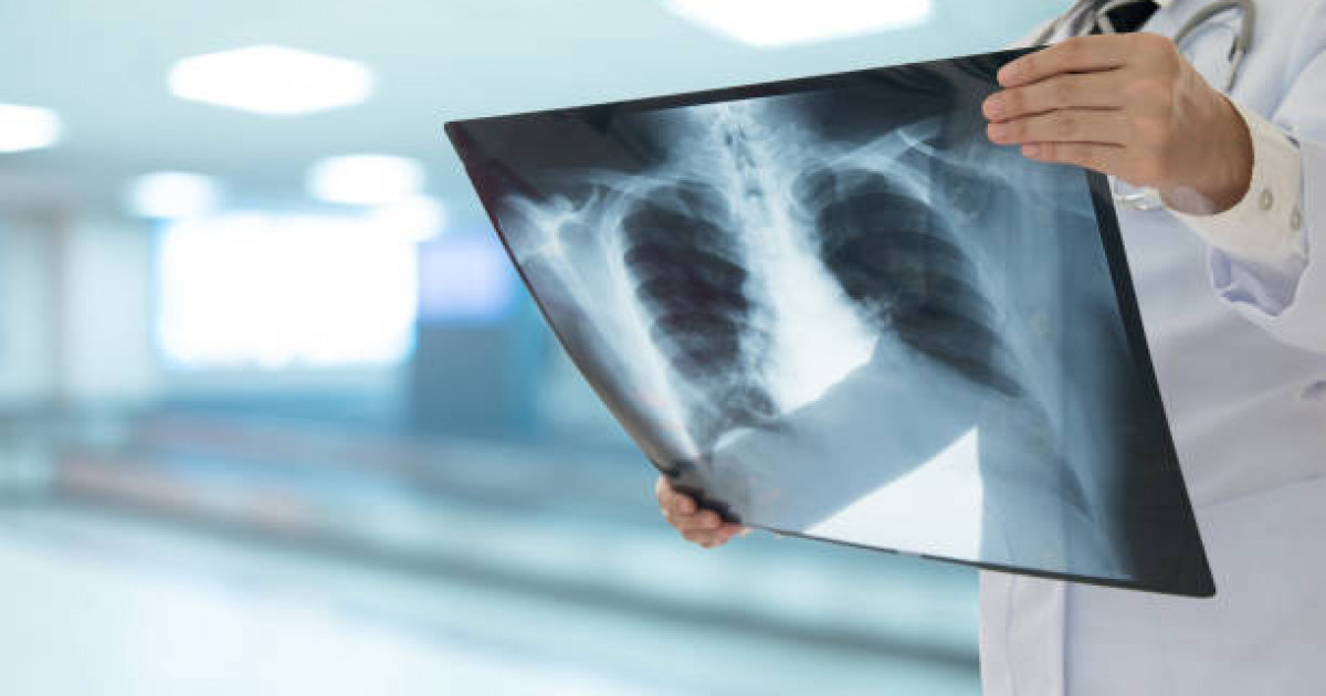 Туберкулезбен ауыратын науқастар саны азайды